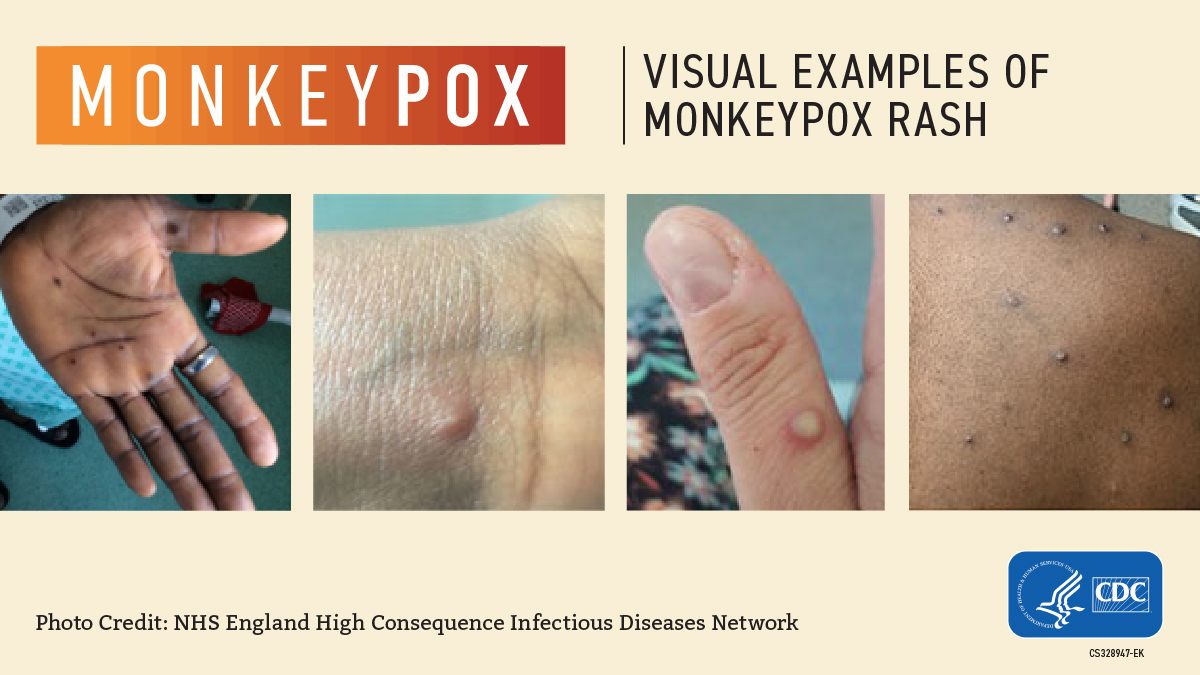 Sharing Monkeypox Sores on Social Media - The New York Times